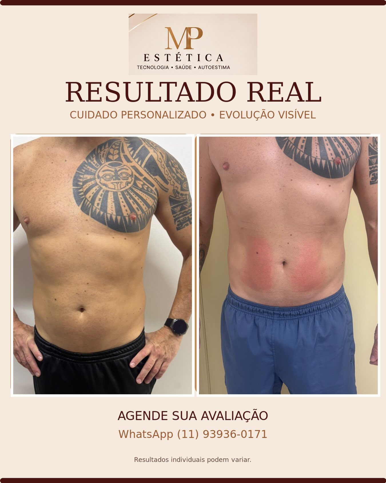 Resultado de tratamento corporal