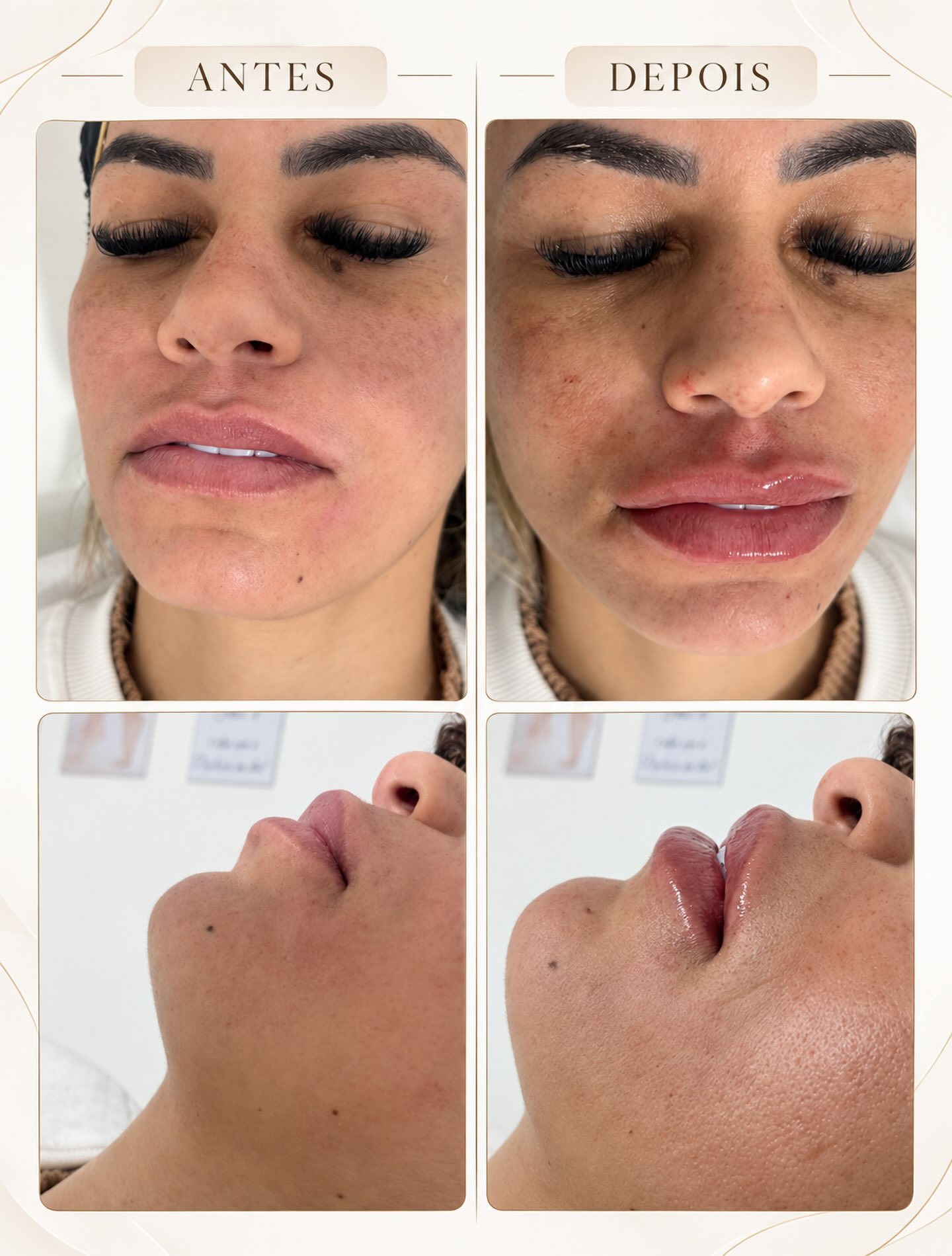 Antes e depois de harmonização facial