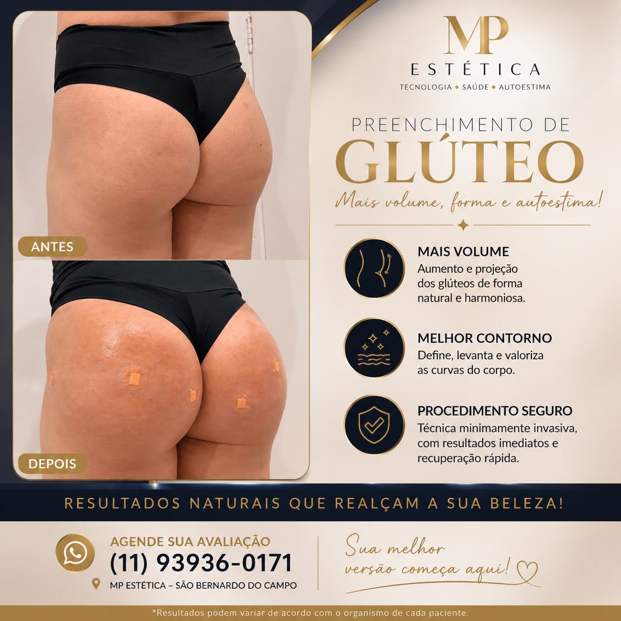 Antes e depois de preenchimento de glúteo