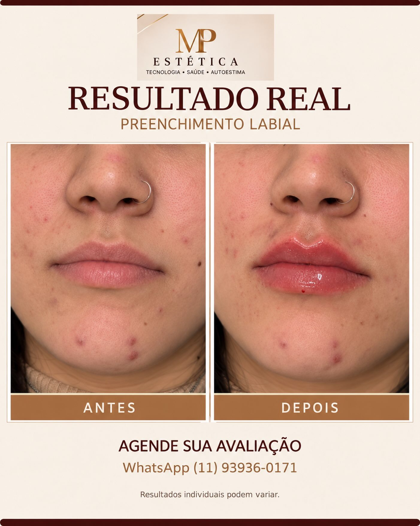 Antes e depois de preenchimento labial