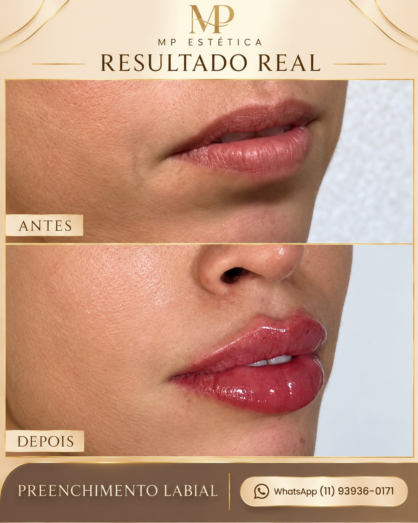 Antes e depois de preenchimento labial