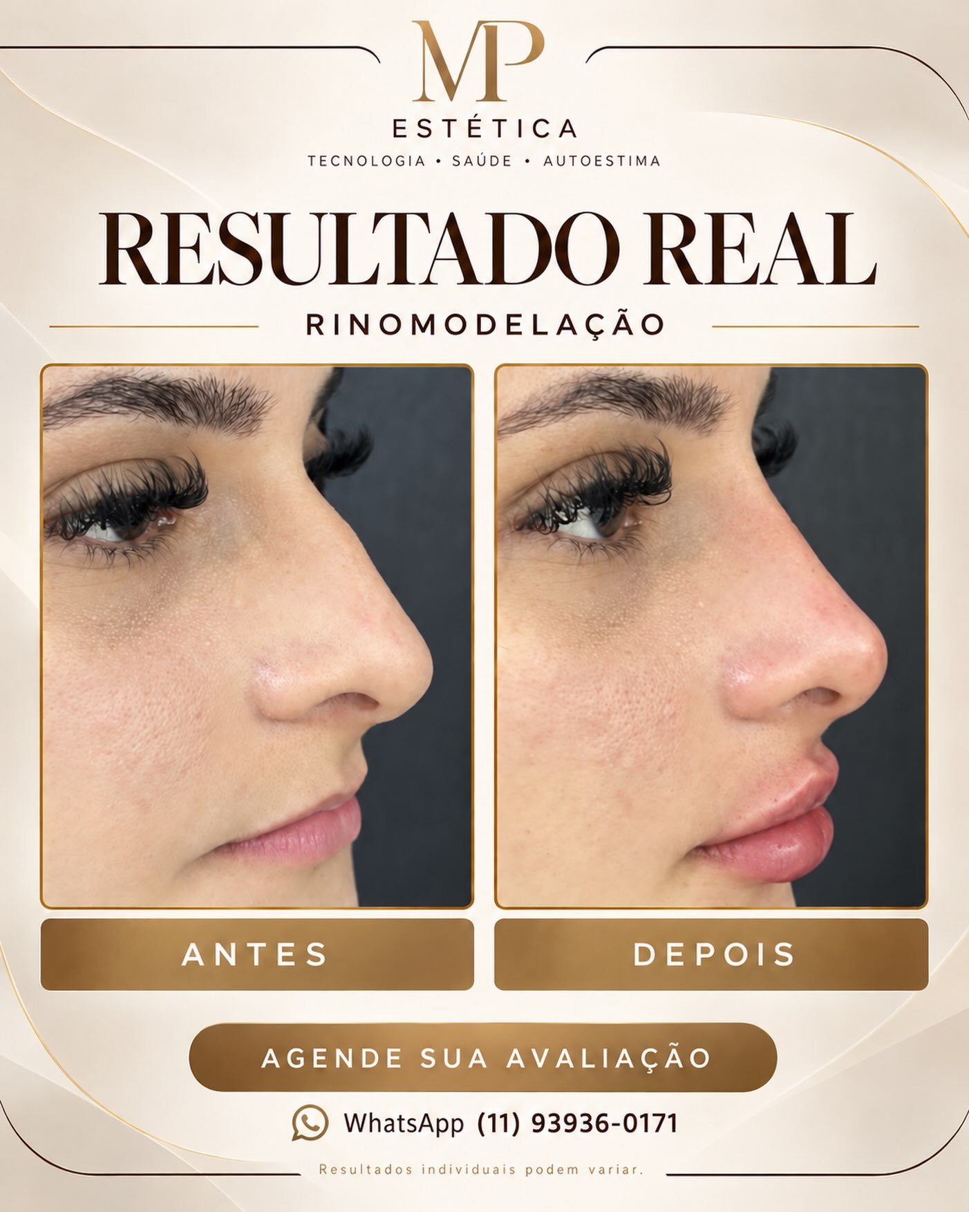 Antes e depois de rinomodelação