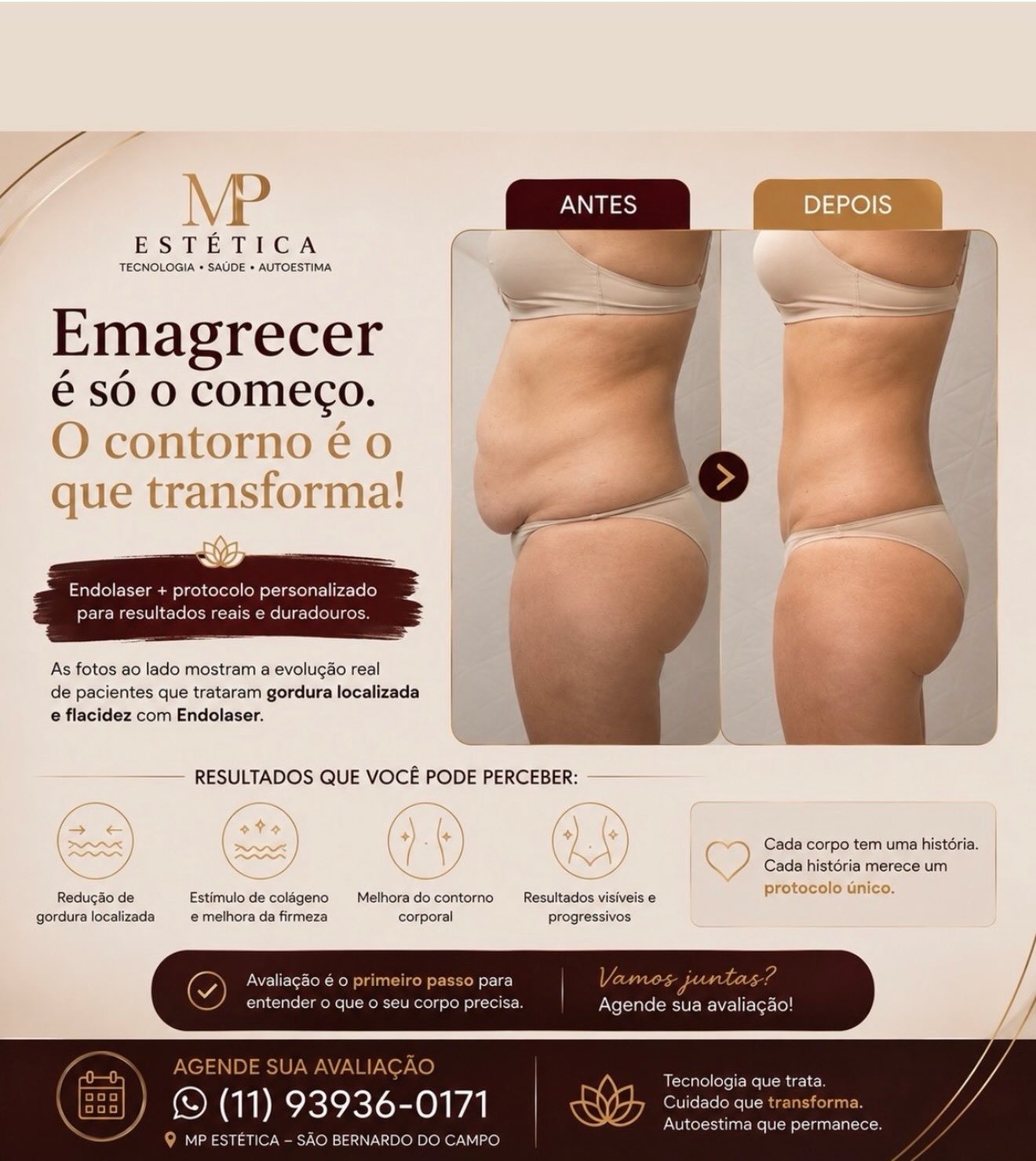 Antes e depois de emagrecimento com Endolaser